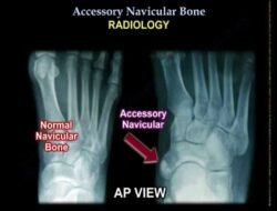 Accessory Navicular Surgery Procedure For Relief And Recovery