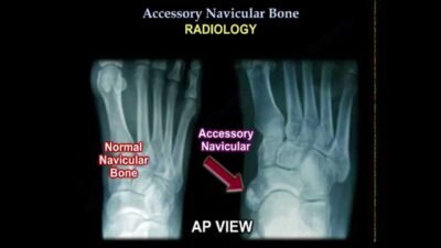 Accessory navicular surgery procedure